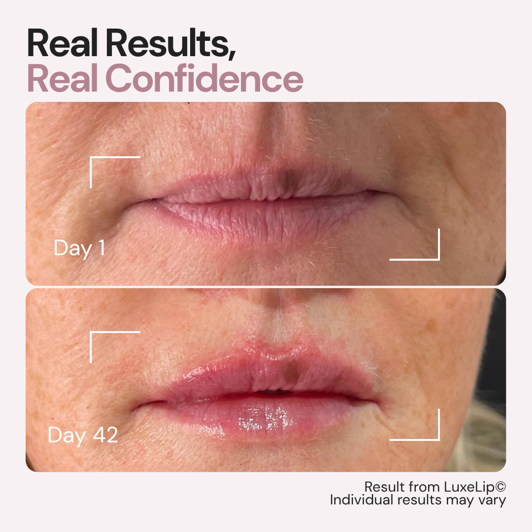 Luxes-Lip - Anti-ageing LED wearable device for youthful lips