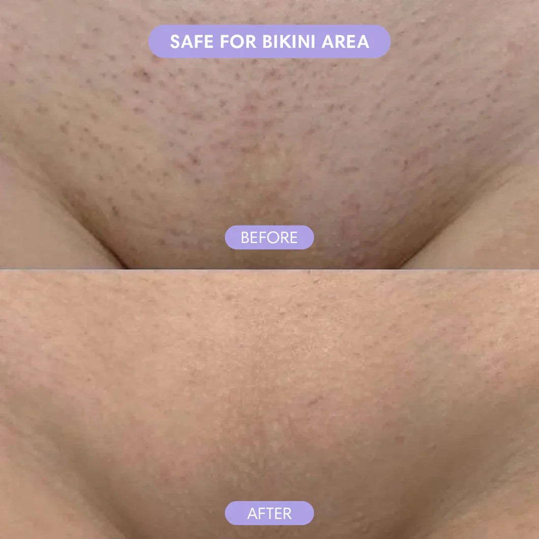 SmoothMist™ - Body Hair Removal Spray