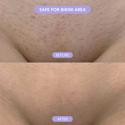 SmoothMist™ - Body Hair Removal Spray