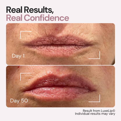 Luxes-Lip - Anti-ageing LED wearable device for youthful lips