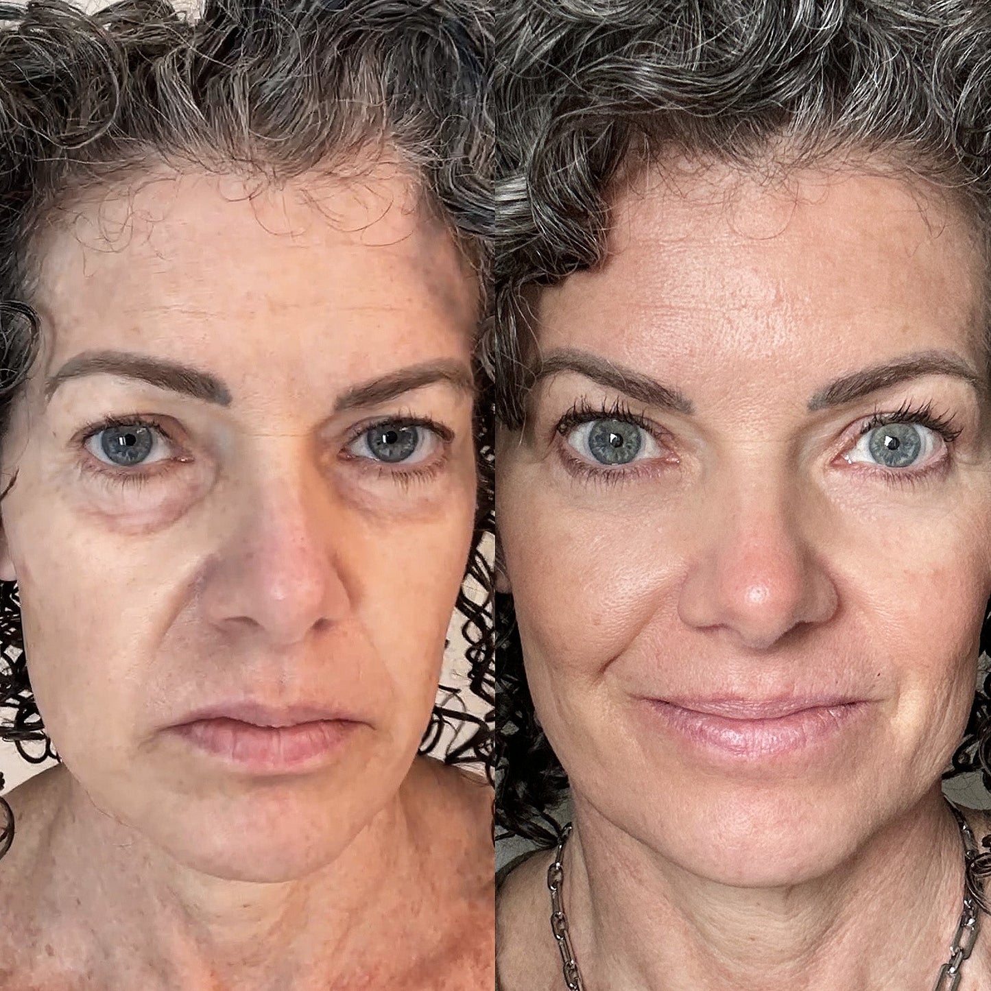LumiLift™ 2-in-1 Red Light Therapy + EMS To Erase Eye Bags