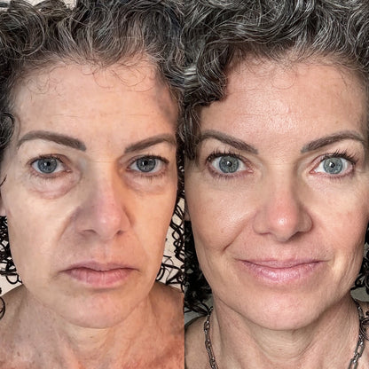LumiLift™ 2-in-1 Red Light Therapy + EMS To Erase Eye Bags