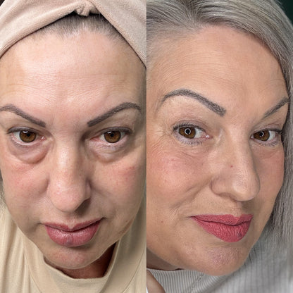 LumiLift™ 2-in-1 Red Light Therapy + EMS To Erase Eye Bags